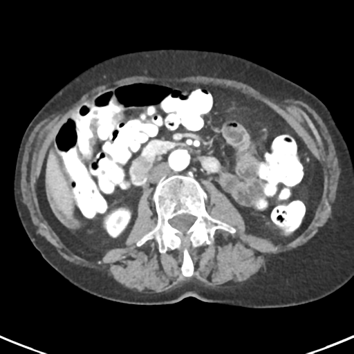Ampullary adenocarcinoma (Radiopaedia 34013-35237 B 47).png