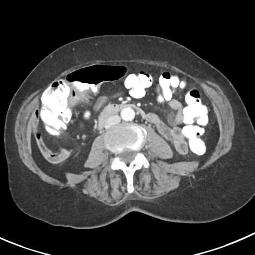 Ampullary adenocarcinoma (Radiopaedia 34013-35237 C 27).png