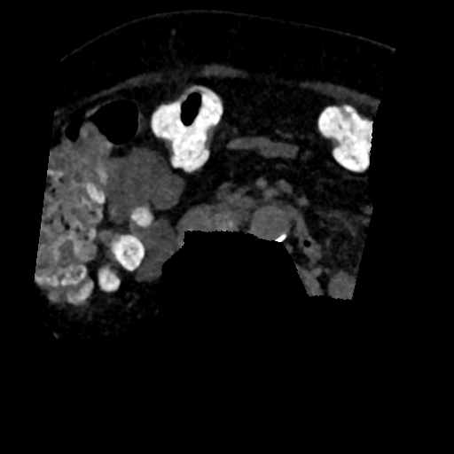 File:Ampullary adenocarcinoma (Radiopaedia 34013-35241 AXIAL MIPS 3-1.5 97).png