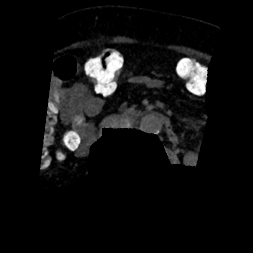 Ampullary adenocarcinoma (Radiopaedia 34013-35241 AXIAL MIPS 3-1.5 98).png