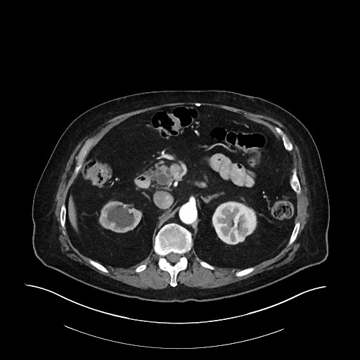 Ampullary adenocarcinoma (Radiopaedia 59373-66734 A 61).jpg