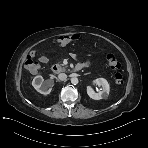 Ampullary adenocarcinoma (Radiopaedia 59373-66737 A 68).jpg