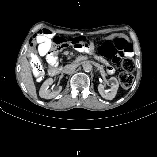 Ampullary adenocarcinoma (Radiopaedia 86093-102033 Axial C+ delayed 45).jpg