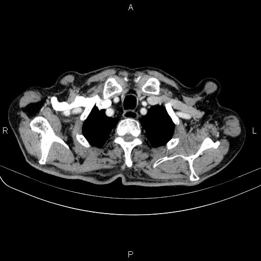 Ampullary adenocarcinoma (Radiopaedia 86093-102033 B 15).jpg