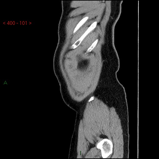 Ampullary carcinoma (Radiopaedia 56396-63056 D 100).jpg