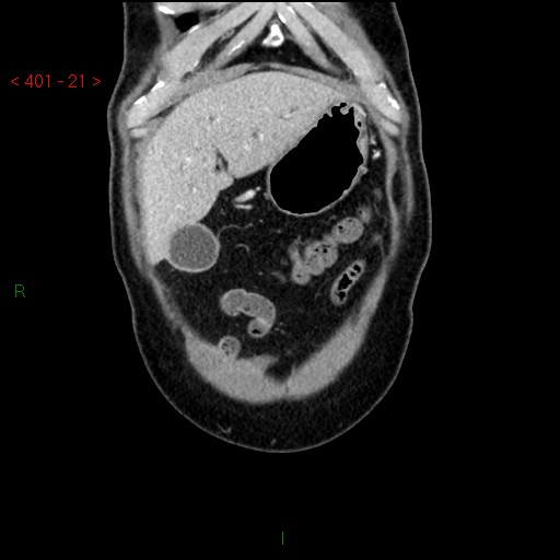 Ampullary carcinoma (Radiopaedia 56396-63056 E 20).jpg