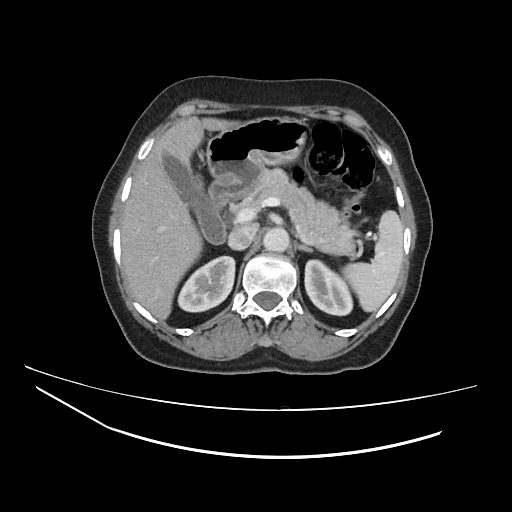 File:Ampullary tumor (Radiopaedia 60333-67998 A 22).jpg