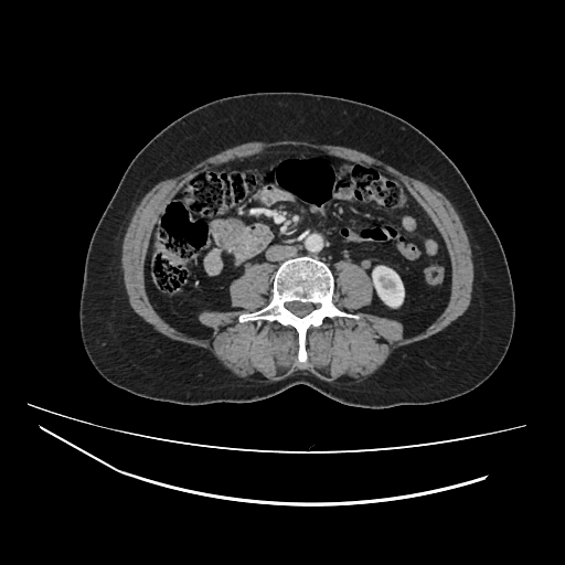 Ampullary tumor (Radiopaedia 60333-67998 A 45).jpg