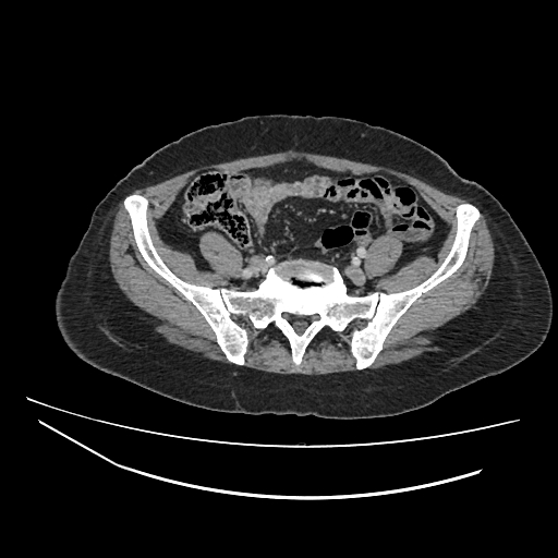 File:Ampullary tumor (Radiopaedia 60333-67998 A 66).jpg