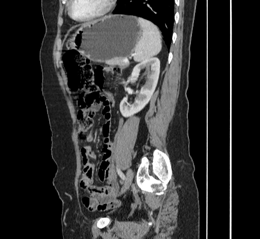 File:Ampullary tumor (Radiopaedia 60333-67998 C 43).jpg