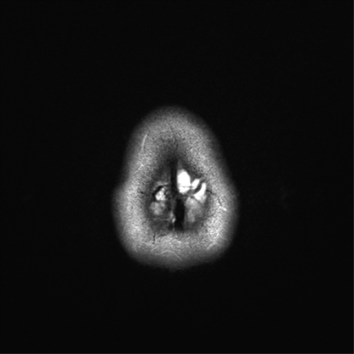 File:Anaplastic astrocytoma IDH mutant (Radiopaedia 50046-55341 Axial T2 37).png