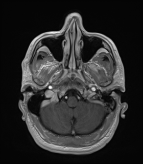 Anaplastic astrocytoma IDH wild-type (Radiopaedia 49984-55273 Axial T1 C+ 11).png