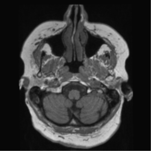 File:Anaplastic astrocytoma IDH wild-type (pseudoprogression) (Radiopaedia 42209-45278 Axial T1 29).png