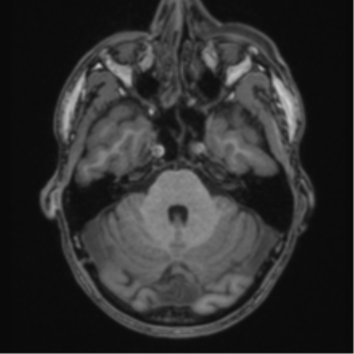 Anaplastic oligodendroglioma with skull fracture (Radiopaedia 74831-85845 Axial T1 14).png