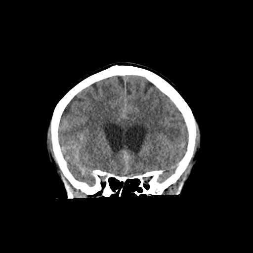 File:Aneursym related subarachnoid hemorrhage with hydrocephalus (Radiopaedia 45105-49083 Coronal non-contrast 21).jpg
