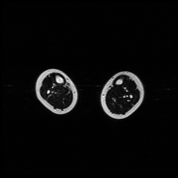 File:Aneurysmal bone cyst - tibia (Radiopaedia 22343-22367 Axial T2 5).jpg