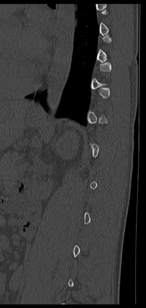 Aneurysmal bone cyst T11 (Radiopaedia 29294-29721 Sagittal bone window 20).jpg