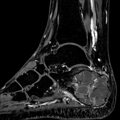 File:Aneurysmal bone cyst of the calcaneus (Radiopaedia 60669-68420 F 26).jpg