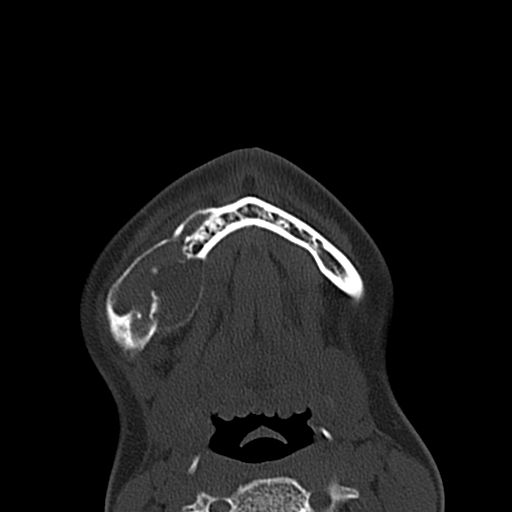 File:Aneurysmal bone cyst of the mandible (Radiopaedia 43280-46601 Axial bone window 9).jpg