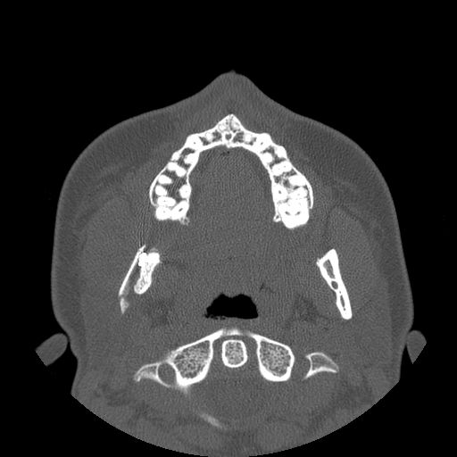 Aneurysmal bone cyst of the mandible (Radiopaedia 43280-46823 Axial bone window 88).jpg