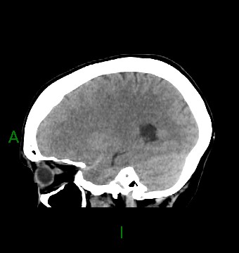 File:Aneurysmal subarachnoid hemorrhage with intra-axial extension (Radiopaedia 84371-99699 B 33).jpg