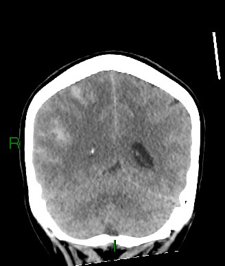 File:Aneurysmal subarachnoid hemorrhage with intra-axial extension (Radiopaedia 84371-99699 Coronal non-contrast 24).jpg