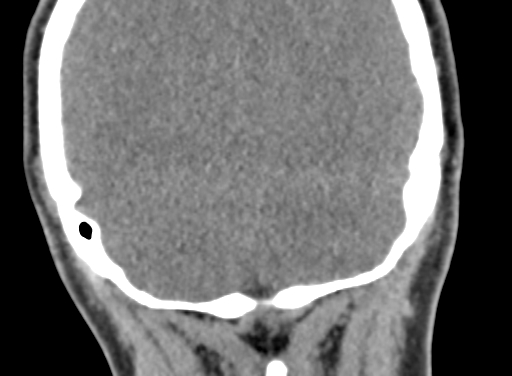 Angular dermoid cyst (Radiopaedia 88967-105790 Coronal non-contrast 104).jpg