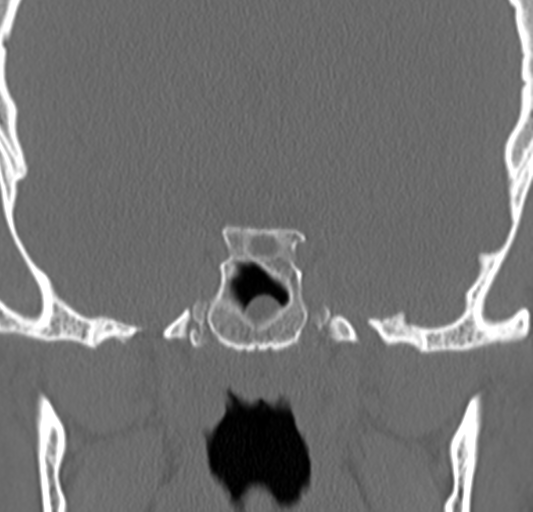 Angular epidermoid cyst (Radiopaedia 46908-51439 Coronal bone window 51).png