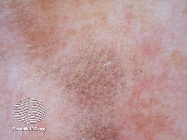 File:Annular granular pattern seen in dermoscopy of lichen planus-like keratosis (DermNet NZ lesions-grey-dots-lplk).jpg