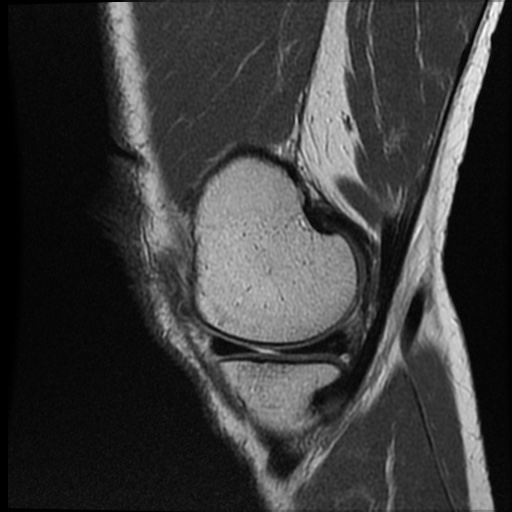 Anomalous insertion of the medial meniscus (Radiopaedia 77559-89721 Sagittal PD 42).jpg
