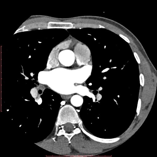 File:Anomalous left coronary artery from the pulmonary artery (ALCAPA) (Radiopaedia 70148-80181 A 76).jpg