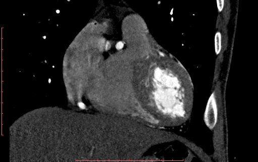 Anomalous left coronary artery from the pulmonary artery (ALCAPA) (Radiopaedia 70148-80181 B 90).jpg