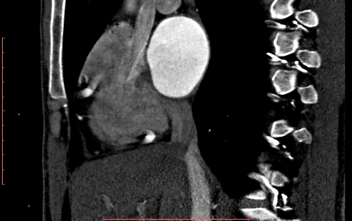 File:Anomalous left coronary artery from the pulmonary artery (ALCAPA) (Radiopaedia 70148-80181 C 64).jpg