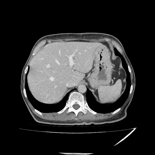 Anorectal carcinoma (Radiopaedia 44413-48064 A 10).jpg