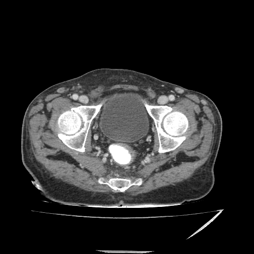 Anorectal carcinoma (Radiopaedia 44413-48064 A 50).jpg