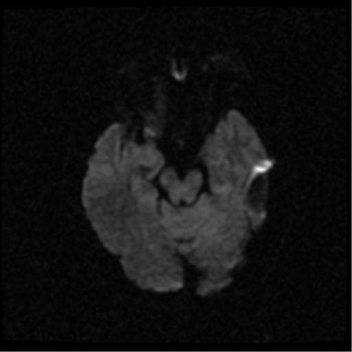 File:Anterior cerebral artery territory infarct (Radiopaedia 39327-41584 Axial DWI 9).png