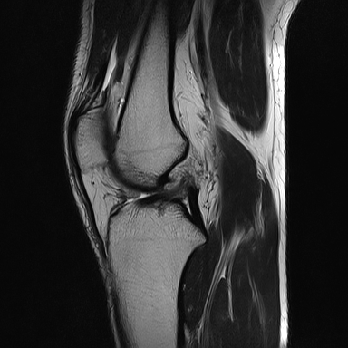 File:Anterior cruciate ligament full thickness tear (Radiopaedia 66268-75467 Sagittal T2 12).jpg