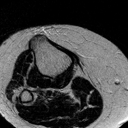File:Anterior cruciate ligament mucoid degeneration (Radiopaedia 60853-68633 Axial T2 1).jpg