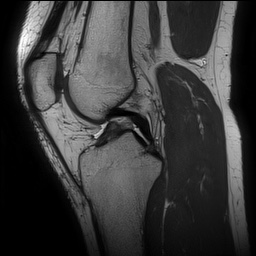 Anterior cruciate ligament rupture and posteromedial corner injury (Radiopaedia 67338-76723 Sagittal PD 81).jpg