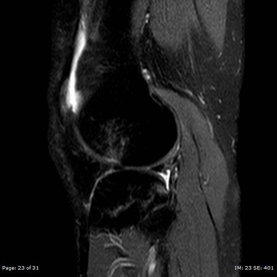 File:Anterior cruciate ligament tear (Radiopaedia 70783-80964 Sagittal STIR 23).jpg