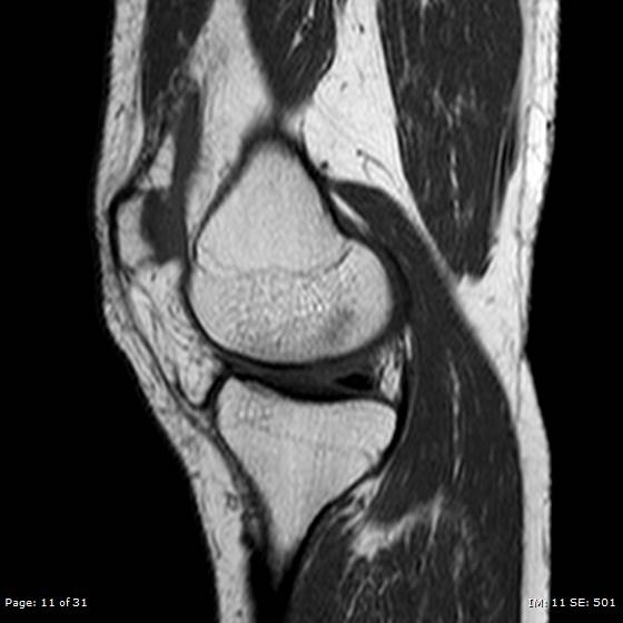 File:Anterior cruciate ligament tear (Radiopaedia 70783-80964 Sagittal T1 11).jpg
