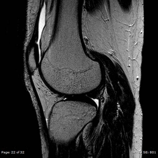 File:Anterior cruciate ligament tear (Radiopaedia 70783-80964 Sagittal T2 22).jpg