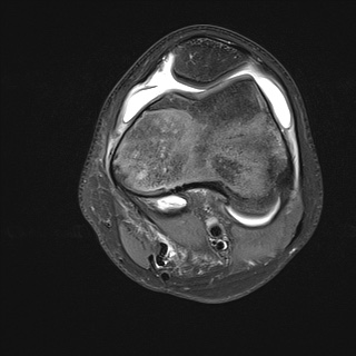 File:Anterior cruciate ligament tear - pediatric (Radiopaedia 62152-70260 Axial PD fat sat 14).jpg