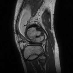 Anterior cruciate ligament tear - pediatric (Radiopaedia 62152-70260 Sagittal PD 141).jpg