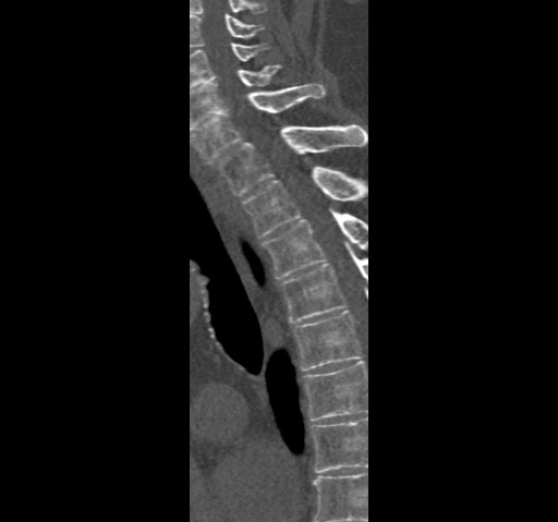 Anterior glenohumeral dislocation with Hill-Sachs lesion (Radiopaedia 62877-71249 Sagittal bone window 84).jpg