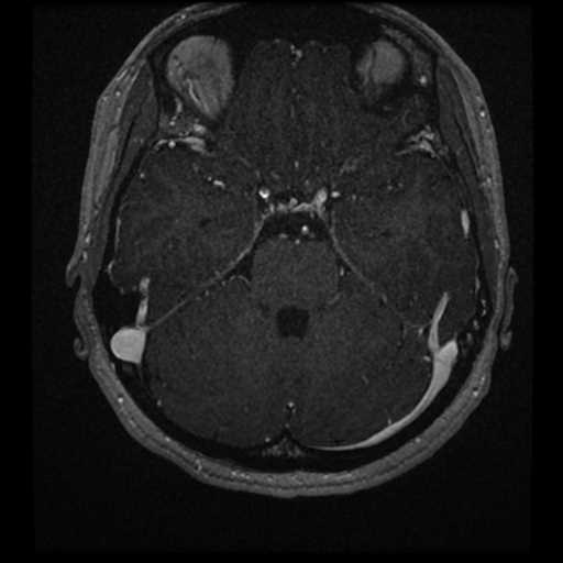 Anterior inferior cerebellar artery vascular loop - type II (Radiopaedia 70991-81209 Axial T1 C+ 15).jpg