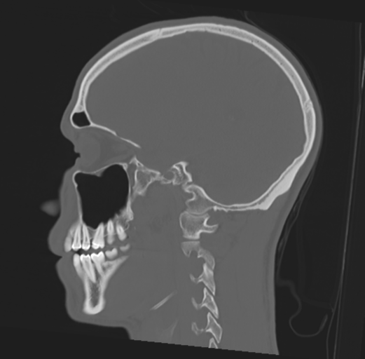 Anterior nasal spine fracture (Radiopaedia 46138-50494 Sagittal bone window 22).png