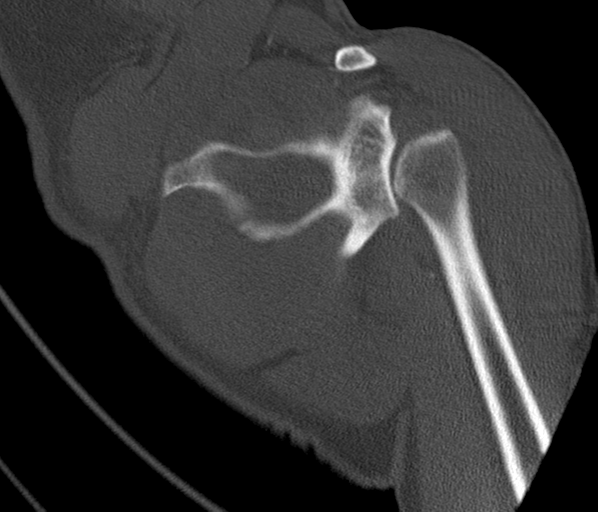 File:Anterior shoulder dislocation with Hill-Sachs and bony Bankart lesions (Radiopaedia 40424-42974 Coronal bone window 30).png
