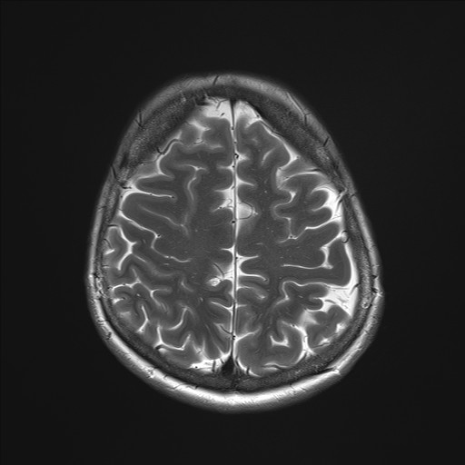 File:Anterior temporal encephalocele (Radiopaedia 82624-96808 Axial T2 31).jpg