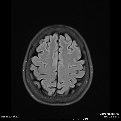File:Anterior temporal lobe perivascular space (Radiopaedia 88283-104914 Axial FLAIR 23).jpg